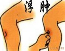 湖北武汉内科有名老中医钟明教授：肾病综合征伴下肢水肿中医治疗有效果