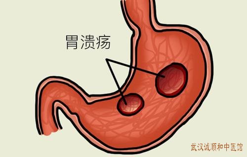 胃溃疡引起泛酸烧心乏力饮食一般喝中药可以恢复吗？