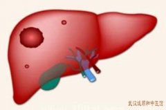 湖北名中医肝癌术后调理刘玉茂教授：肝癌术后胸腔积液中医怎么调理好