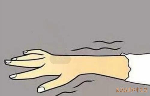 武汉治疗颈椎好的中医院专家王垚神经根型颈椎病医案一则