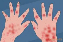 武汉疑难杂症老中医宋跃进坐诊：红斑狼疮关节肿痛伴头晕怎么缓解症状