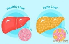 湖北省中医院退休专家李轩锦：脂肪肝右胁隐痛腰酸乏力中医能治好吗?