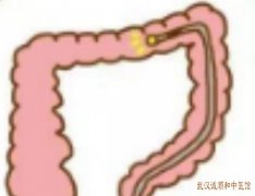 武汉中南路脾胃病专家张林茂：溃疡性结肠炎黏液脓血便用什么中药治疗？