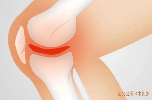 湖北武汉骨病中医院专家王垚膝骨关节炎医案一则