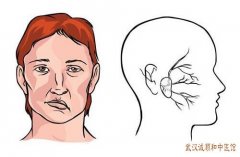 面瘫、嘴歪、眼斜需要当心特发性面神经麻痹！中医采用分期论治的原则治