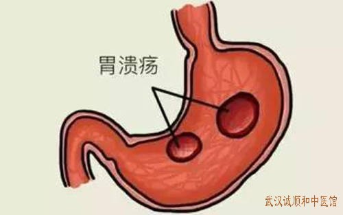 武昌中南路专治脾胃病的中医吴永贵慢性胃溃疡医案一则