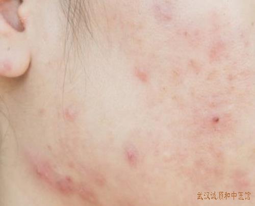 原南京三甲医院退休专家胡爱玲：脂溢性皮炎面颊有痤疮中医治疗效果如何?