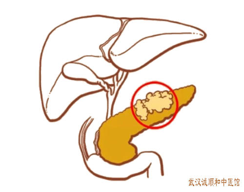 湖北省中医世家内科医师让敏：慢性胰腺炎右肋间及后背胀痛口中酸涩中医调理效果如何?