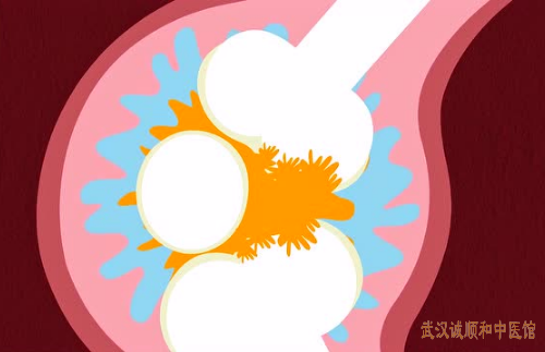 　武汉诚顺和疼痛门诊老中医柳新樵：双膝关节滑膜炎局部肿胀疼痛感明显针药并治效果好吗?