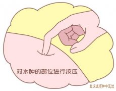 武汉市武昌区有位厉害的老中医钟明：双下肢水肿夜间加重检查没有明显问