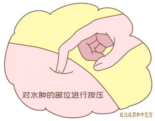 武汉市武昌区有位厉害的老中医钟明水肿医案一则