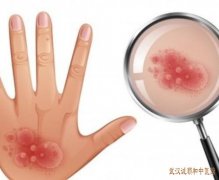 带状疱疹后遗神经痛多发老年患者中医药治疗效果好不好?
