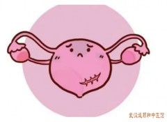 子宫腺肌病会导致不孕吗？经期总是延后经量大伴下腹剧痛吃什么中药方子
