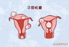 患子宫肌瘤平素急躁易怒吃什么中药调理气滞血瘀效果好？