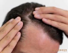 头顶出现斑秃是什么原因?中医治疗原则以及用什么治疗方式效果好?
