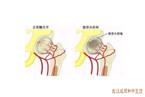 股骨头坏死