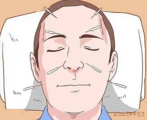 面神经炎导致面瘫右侧口眼歪斜下垂流涎怎么治好？