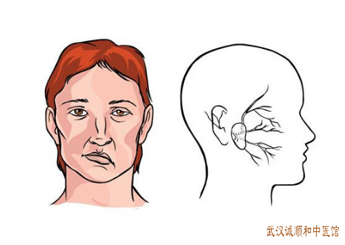 面瘫右侧面部口眼歪斜不能皱额右眼睑无法闭合怎么治疗好？