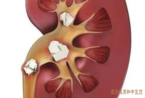 湿热型虚热型实型气滞血瘀型泌尿结石症的中医治法和中药方子有哪些？