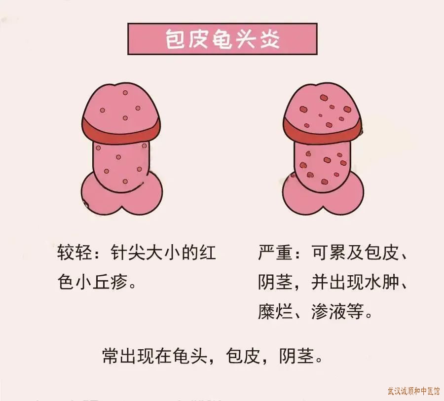 包皮龟头炎