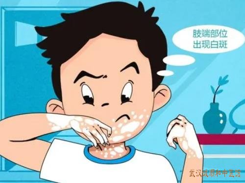 白癜风眼干脱发多梦转氨酶高是怎么回事呢用什么中药方调理比较好？
