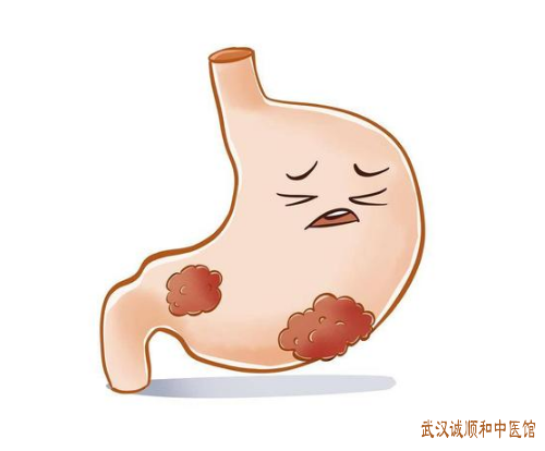 慢性萎缩性胃炎