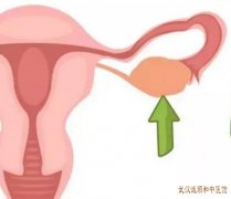 卵巢囊肿下腹不适感腹部胀满食欲不振中医治疗有哪些方法疗效好？