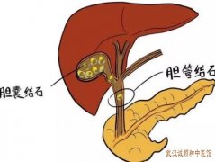 武汉有个厉害的疑难杂症中医：胆结石右上腹剧烈疼痛厌食恶心吃什么药治