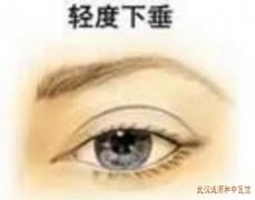 小心重症肌无力引起眼皮掉下来老是睁不开吞咽困难中医如何治疗？