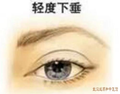 小心重症肌无力引起眼皮掉下来老是睁不开吞咽困难中医如何治疗？