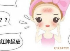 风疹面部淡红色斑点发热咳嗽伴有打喷嚏流涕中医怎么治疗？