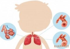 武汉中南路有名的儿科专家：中医怎么辨证加减治疗小儿支气管肺炎?