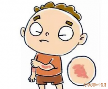四肢伸侧处发起大片红色风疹团伴瘙痒中医怎么样治疗荨麻疹有效？