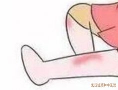 武汉银泰附近中医皮肤门诊：手足癣危害大建议尽早治疗预防!