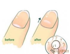 武汉街道口有位看皮肤病厉害的老中医：中医学对甲癣如何辨证?