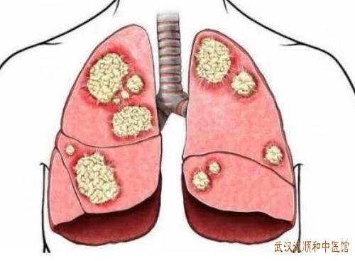 武汉汉正街附近看肿瘤的老中医专家：胸腔积液口干咳喘伴咳痰不爽如何调？