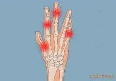 武汉洪山区有位靠谱的骨病中医：肩背部疼痛双手指关节疼痛倦怠乏力怎么