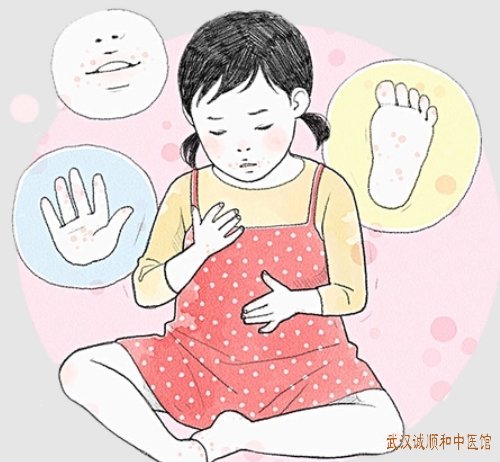 武汉解放路皮肤科老中医门诊部：神经性皮炎双侧手掌肥厚性丘疹瘙痒剧烈用啥中药治好？