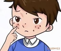 武汉武昌中医皮肤病专家门诊：反复发作性痒疹数年加重半月中医怎么辨证