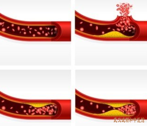武汉江汉路附近看心脑血管疾病的老中医:高脂血症反复发作血脂异常中医怎么调理有用?