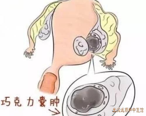 武汉梅苑小区附近治妇科的老中医:双侧卵巢囊肿左少腹隐疼腰酸伴带多质稀怎么治好?