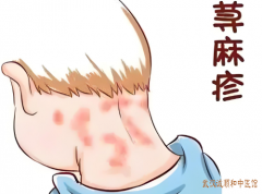 武汉徐家棚中医皮肤病专家门诊:中年女性荨麻疹周身痒剧风团颜色深红掌