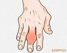 武汉积玉桥街道有个看中医疼痛骨病的老中医：类风湿性关节炎小关节呈对