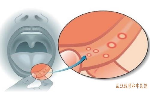 武汉厉害的口腔科中医专家:中年人口腔溃疡反复发作口干口苦伴大便不成形如何调理好?