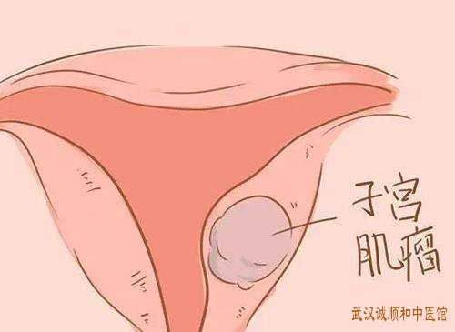 武汉有名的妇科中医医生推荐：子宫肌瘤小腹冷痛拒按得热则减伴经色暗紫夹血块中医怎么调？