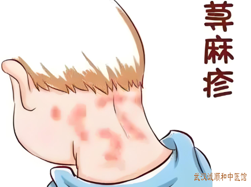 武汉哪家医院皮肤科比较专业？老人荨麻疹反复发作半年浑身起疹瘙痒难忍中医怎么辨证论治？
