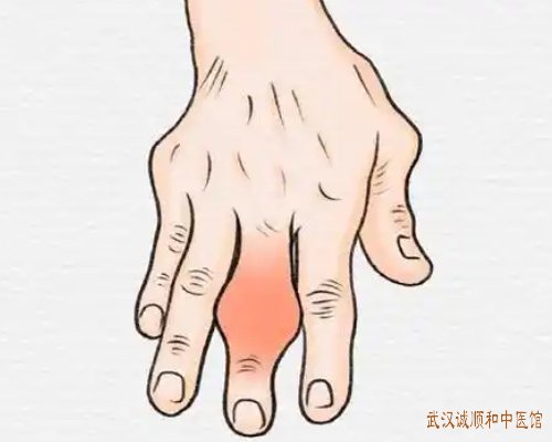 武汉哪里有看痛风的中医院:夜间突然出现受累关节剧痛难忍痛风性关节炎中医怎么辨证?